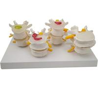 Spine Lumbar Disc Herniation Model Human Vertebral Body Lesion Model Lumbar Disc Herniation Anatomical Model