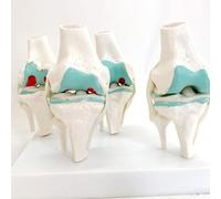 SSDDLZEQ Human anatomical model Human Anatomy Model Knee Model 4 Level Anatomy Human Pathological Degenerative Knee Model For Pathological Disease Medical Research
