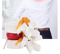 SSDDLZEQ Human anatomical model Human Lumbar Disc Herniation Anatomical Model Human Spine Anatomical Model Human Spine Lumbar Spine 1:1.5 Medical Demonstration Model