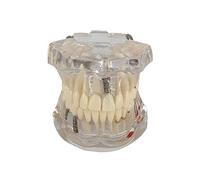 Standard Dental Teeth Model, Dental Disease Teaching Dental Teaching Study Demonstration Model, for Hospital Dentists