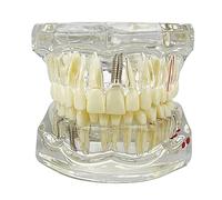 Standard Dental Teeth Model Implant Disease Dentist Studying Demo Dental Typodont Model With Removable Teeth Restoration Bridge(White)