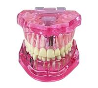 Standard Dental Teeth Model Implant Disease Dentist Studying Demo Dental Typodont Model With Removable Teeth Restoration Bridge(Pink)