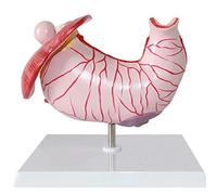 Stomach Anatomical Model - Gastritis Model Gastric Lesion Model - Gastric Pathology Gastritis Ulcer Medical Model - Human Organ Anatomical Anatomy Model