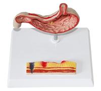 Stomach Anatomy Model,Gastric Perforation Gastric Pathology Model: Gastritis, Ulcer & Pathology Learning Tool For Medical Education