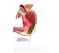 Stomach Disease Model, Human Digestive System Anatomy for Medical Teaching, Educational Demonstration Model for Anatomy Study, 3D Display for Clinics and Schools