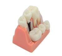 Teach Implant Analysis Crown Bridge Removable Demonstration Teeth Model for Doctor-Patient Communication Implant Teeth Model for Studying Teaching Module Medical Science Dentist