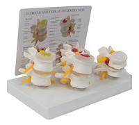 Teaching Model tool,Human Spine Model Detailed Pathological Lumbar Spine with English Reference Card, Herniated Discs, Bone and Disc Degeneration Advanced Osteoporosis