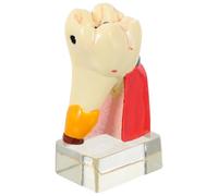 Teeth Demonstration Model Four Times Tooth Decay Resin Teaching