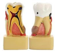 Teeth Model, 6 Times Caries Comparative Study Models, Dental Anatomy Education Teeth Model For Dentist Studying Researching Teaching Aids