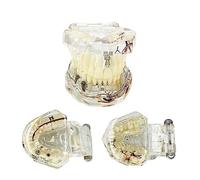 Teeth Model, Dental Transparent Pathology Tooth Model,with Nerve Mouth Model, Standard Pathology Teaching Model,for Patient and Dental Student Education Study