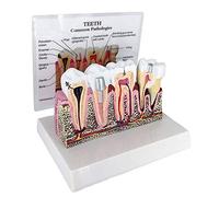 Teeth Model Patient Education Dental Model wiht Detailed Instructional Card Diseased Teeth Cross-Section Model Gums for Education