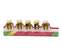 Teeth Periodontal Disease Model Dental Caries Breakdown Display Model Teaching Tooth Model Perio Disease Assort Demo