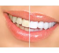 Teeth Whitening Treatment for Two Upper and Lower Bleaching Trays Plus Whitening Kit (3x3ML Syringes)