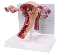 TGPSMDXKV Uterus Ovary Model Pathological Uterus Ovary Anatomical Model Anatomy Cross Section Study Tool for Study Teaching