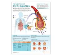 The Anatomy of Type 2 Diabetes Poster, 45x60 cm, 18x24 inches, Diabetes Anatomical Chart, Type 2 Diabetes Mellitus Diagram