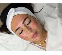 THE MILLION DOLLAR FACIAL - MICRO NEEDLE