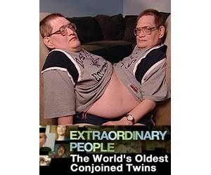 The World's Oldest Conjoined Twins
