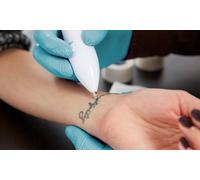 Three session: laser tattoo removal on a 8cm x 8cm area
