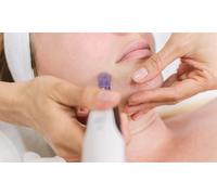 Three Sessions: Microneedling with 24K Gold & Hyaluronic Acid Facial Skin Serum