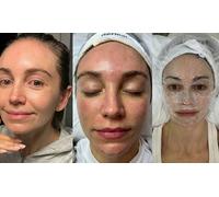 Three Sessions of Medical Microneedling facial with hyaluronic acid