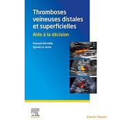 Thromboses veineuses distales et superficielles: Aide à la décision