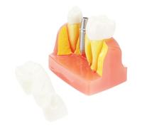 Times Teeth Model Teaching Demonstration Resin Model | Removable Teeth, Fixed Prosthesis Included, Anatomy for Patient Understanding and Hands-on Practice