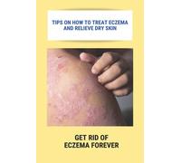 Tips On How To Treat Eczema And Relieve Dry Skin: Get Rid Of Eczema Forever: Overcome Eczema
