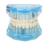 Tooth Model, Disease Teeth Model, Detachable Mouth Model, Compatible Blue Dental Models For Teaching And Communicating With Patients