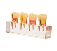 Totority Realistic Teeth Model for Pediatric Caries Progression with Resin Oral Anatomy Design, Supports Dentist-patient Communication, for Students and Disease Teaching