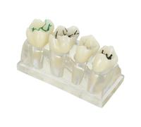 Toyvian Caries Teeth Model for Dentists and Oral Students, Abs Material Oral Teaching Teeth Model Showing Types of Cavities, for Patient Communication and Clinical Demonstration