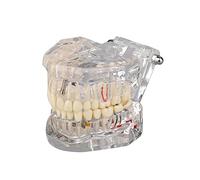 Transparent Disease Teeth Model