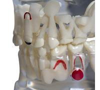 Transparent Disease Teeth Model,Transparent Children Dental Model for Primary Teeth Deciduous Teeth Model for Teaching Demonstration