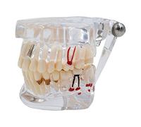 Transparent Teeth Model - Removable Adult Tooth Study Model, Typodont Pathological Disease Implant Teaching Tools