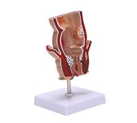 Tuidzljd Anatomy Model Human Rectal Lesion Model Fistula Fistula Fissure Pathology Teaching Model