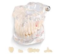 Uadme Standard Transparent Disease Teeth Model, with Implants & Removable Teeth, Tooth Pathological Teaching for Anatomy Demonstration, Disease Presentation & Implantology Study