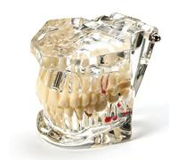 Uadme Transparent Disease Teeth Model, Implants & Removable