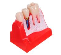 ULTECHNOVO Realistic Model for Patient Education and Student Training Enlarged Bridge Demonstration Tool Portable High Fidelity Teeth Practice Aid for Teaching and Clinical Use