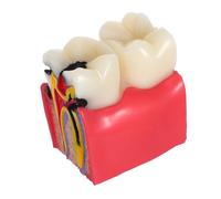 ULTECHNOVO Tooth Anatomy Teaching Model with Realistic Caries Simulation for Patient Education and Student Study Comparative Decay Tool for Classroom and Dentist Use