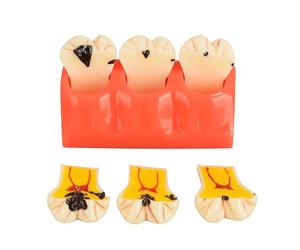 Ultrassist Dental Caries Teeth Model 4 Times Dental Tooth Decay Model Caries Bilateral Comparison Pathology Model Teeth for Dental Education Supplies, Tooth Pathology Display