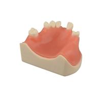 Ultrassist Maxillary Dental Implant Model, Basic Implant Training Model with Practice Soft Gums, Great Dental Training Tooth for Dental Implant Practice