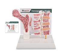 Ultrassist Osteoporosis Model, Human Vertebrae Anatomical Model For Teaching Demonstration with Study Card