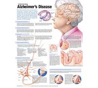 Understanding Alzheimer's Disease