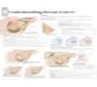 Understanding Breast Cancer Laminated Poster