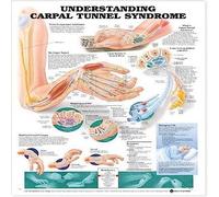 Understanding Carpal Tunnel Syndrome Anatomical Chart