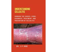 UNDERSTANDING CELLULITIS: KNOWING THE CAUSES, SIGNS, DIAGNOSIS, TREATMENT, AND PREVENTION OF CELLULITIS