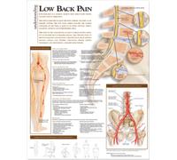 Understanding Low Back Pain Anatomical Chart