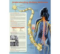 Understanding Multiple Sclerosis