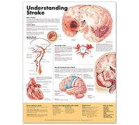 Understanding Stroke