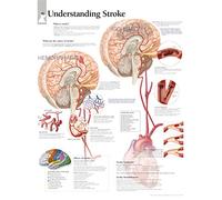 Understanding Stroke Laminated Poster