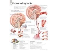Understanding Stroke Paper Poster